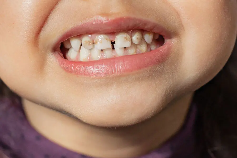 Bambino con denti irregolari e cura dentale