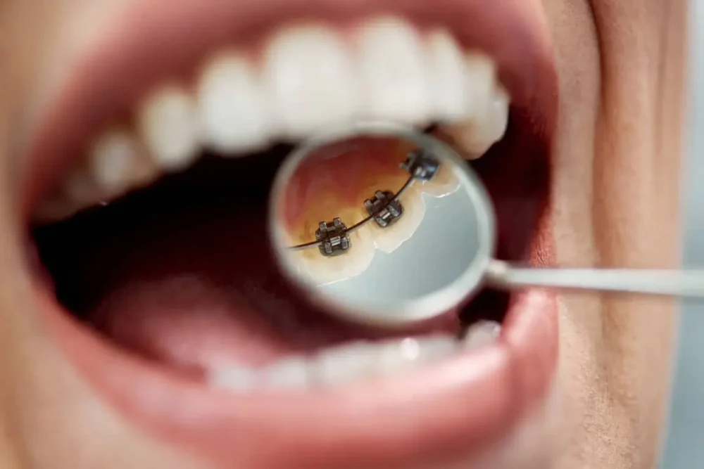 Primo piano di denti con apparecchio