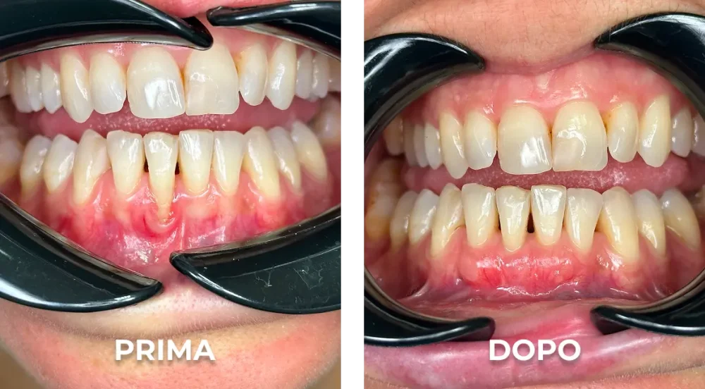 Confronto denti prima e dopo