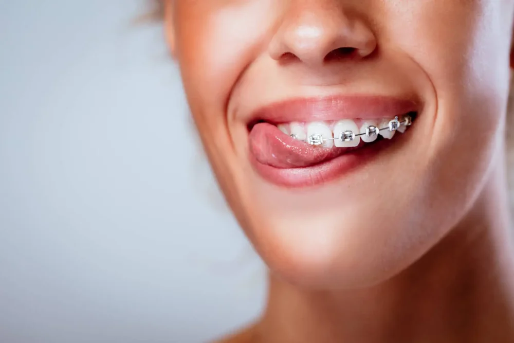 Sorriso con apparecchio ortodontico