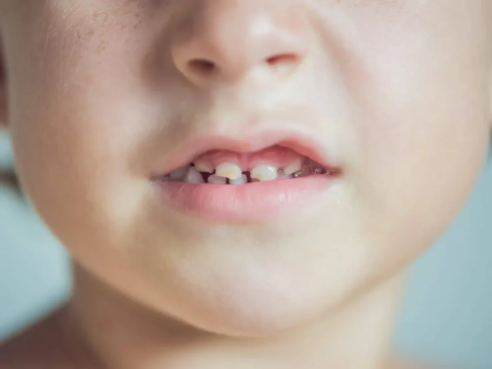 Sorriso infantile con denti da latte